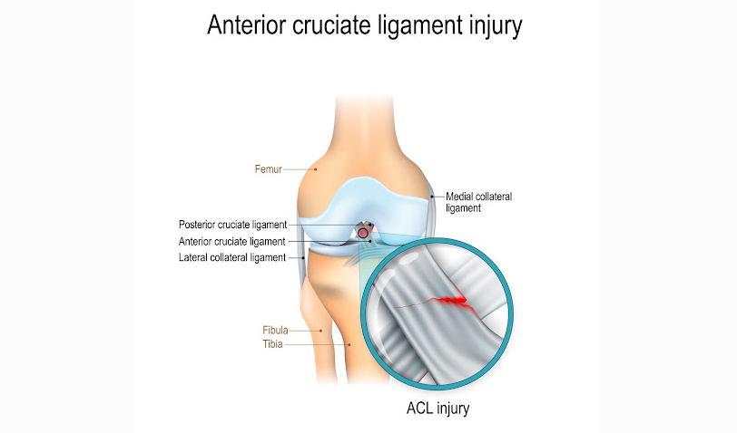When Should You Get The ACL Reconstruction In Singapore 1