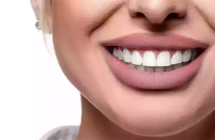 Benefits of Hollywood Smile in Turkey